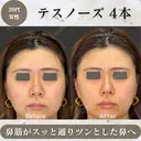 テスノーズ before画像 サムネイル用