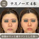 テスノーズ after画像 サムネイル用