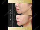 貴族リフト8本🫅 after画像 サムネイル用