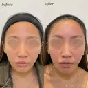 額　ヒアルロン酸注入 before画像 サムネイル用