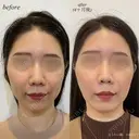 ほうれい線ヒアルロン酸注入 before画像 サムネイル用