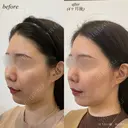 ほうれい線ヒアルロン酸注入 after画像 サムネイル用