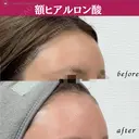 ヒアルロン酸（額） before画像 サムネイル用
