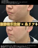 💉脂肪吸引注射＋🪡糸リフトでくっきりフェイスライン、小顔を実現😉 before画像 サムネイル用