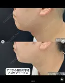 💉脂肪吸引注射＋🪡糸リフトでくっきりフェイスライン、小顔を実現😉 30日後 サムネイル用