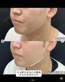 💉脂肪吸引注射＋🪡糸リフトでくっきりフェイスライン、小顔を実現😉 30日後 サムネイル用