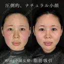 Wing小顔女神脂肪吸引 before画像 サムネイル用