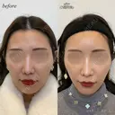 額ヒアルロン酸注入 before画像 サムネイル用