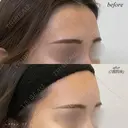 額ヒアルロン酸注入 after画像 サムネイル用