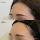 額ヒアルロン酸注入 after画像 サムネイル用