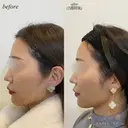 額ヒアルロン酸注入 after画像 サムネイル用