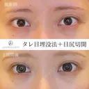 タレ目埋没法＋目尻切開 before画像 サムネイル用