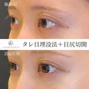 タレ目埋没法＋目尻切開 14日後 サムネイル用