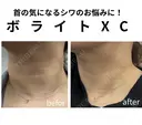 アラガン社製ボライトXC before画像 サムネイル用