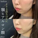 アゴのヒアルロン酸(ボラックス2cc) before画像 サムネイル用