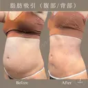 腹部脂肪吸引セット after画像 サムネイル用