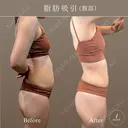 腹部脂肪吸引セット after画像 サムネイル用