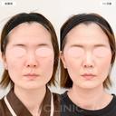 【1day小顔＋エラボトックス】1day小顔脂肪吸引とエラのボトックス注射でお顔の余白が減りました！処置前と1ヶ月後の症例です before画像 サムネイル用