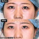 目の下の脂肪とり before画像 サムネイル用