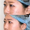 目の下の脂肪とり after画像 サムネイル用