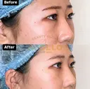 目の下の脂肪とり after画像 サムネイル用