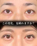 眉下切開 before画像 サムネイル用
