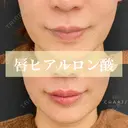 ヒアルロン酸 before画像 サムネイル用