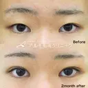 二重埋没法 before画像 サムネイル用