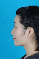 鼻中隔延長術・鼻骨骨切り幅寄せ before画像 サムネイル用
