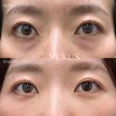 切らない目の下のたるみ取り＋脂肪注入（目の下〜ゴルゴ） before画像 サムネイル用
