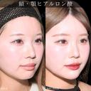 額・顎ヒアルロン酸注入 after画像 サムネイル用
