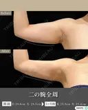 脂肪吸引（二の腕・ブラファット） after画像 サムネイル用