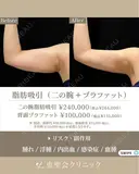 脂肪吸引（二の腕・ブラファット） after画像 サムネイル用