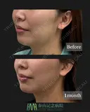 頬＋あご下脂肪吸引 before画像 サムネイル用