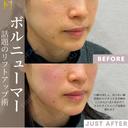 ボルニューマー before画像 サムネイル用