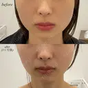 エラボトックス after画像 サムネイル用