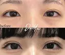 ルラ二重(埋没法) after画像 サムネイル用