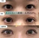 ルラライン二重術(埋没法) before画像 サムネイル用