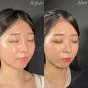 鼻整形－複合－ before画像 サムネイル用