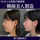 横顔美人は顎下脂肪吸引で作れる✨ 90日後 サムネイル用