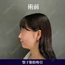 横顔美人は顎下脂肪吸引で作れる✨ 90日後 サムネイル用