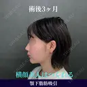 横顔美人は顎下脂肪吸引で作れる✨ 90日後 サムネイル用