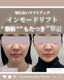 インモードリフト l 切らずにボリュームダウン after画像 サムネイル用