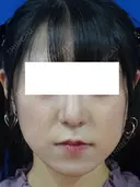 鼻尖縮小+鼻翼縮小（外側） 90日後 サムネイル用
