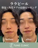 ララピール after画像 サムネイル用