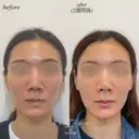 カスタマイズヒアルロン酸注入 before画像 サムネイル用