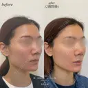 カスタマイズヒアルロン酸注入 after画像 サムネイル用