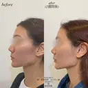 カスタマイズヒアルロン酸注入 after画像 サムネイル用