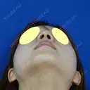 鼻尖縮小+鼻翼縮小（外側） before画像 サムネイル用