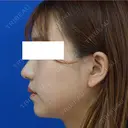 鼻尖縮小+鼻翼縮小（外側） 90日後 サムネイル用